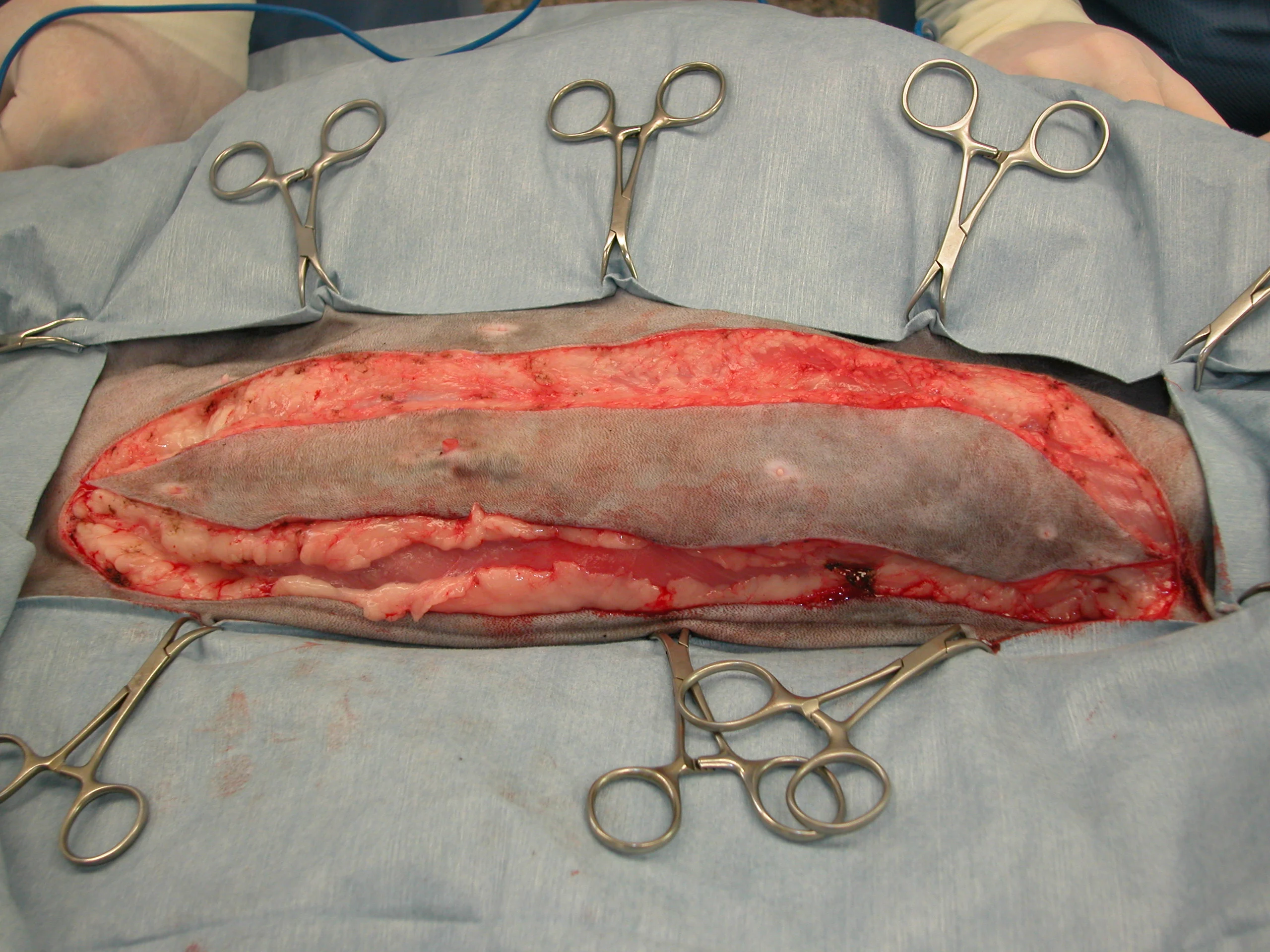 Before and after surgical images of unilateral radical mastectomy with removal of multiple tissue layers.