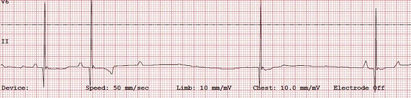 ECG tracing showing AV block.
