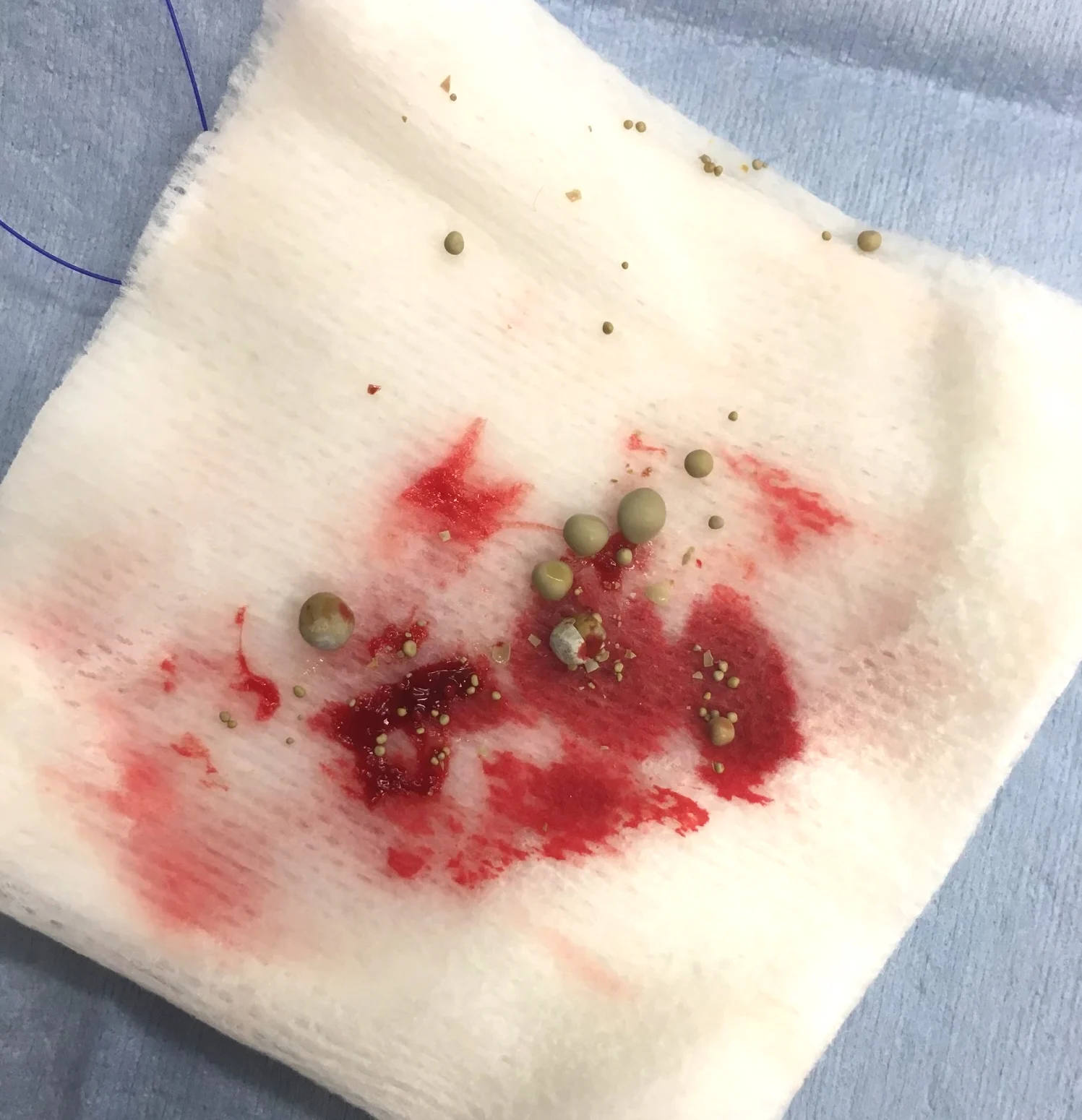 Several smooth, greenish/gray urinary stones of various sizes rest on a piece of surgical gauze.
