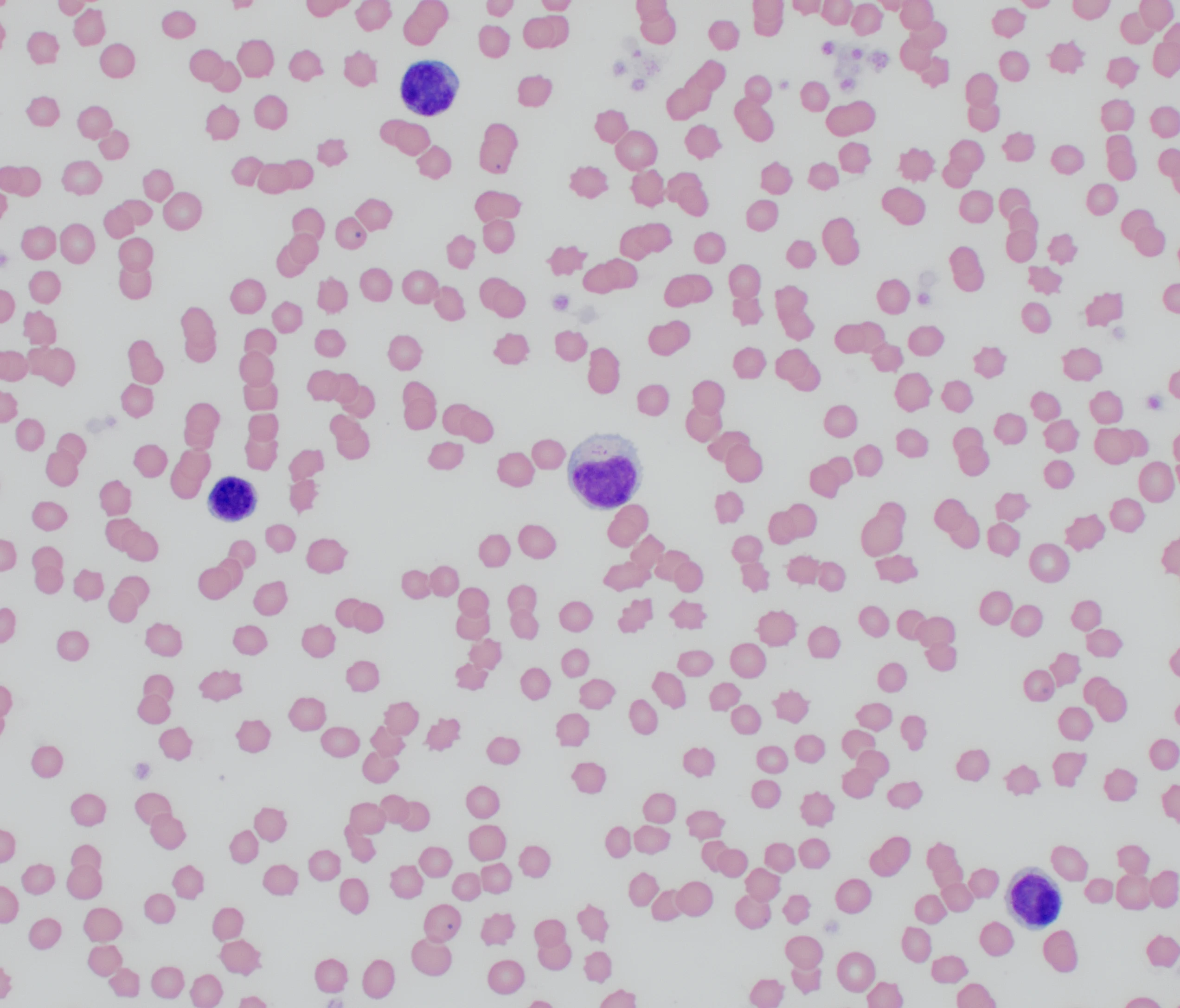 Side-by-side blood smears showing numerous red blood cells and several white blood cells.