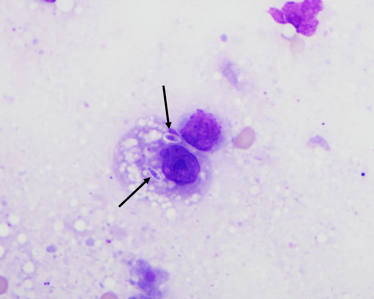 Arrows pointing to 2 ovoid structures within foamy cytoplasm of a white blood cell.