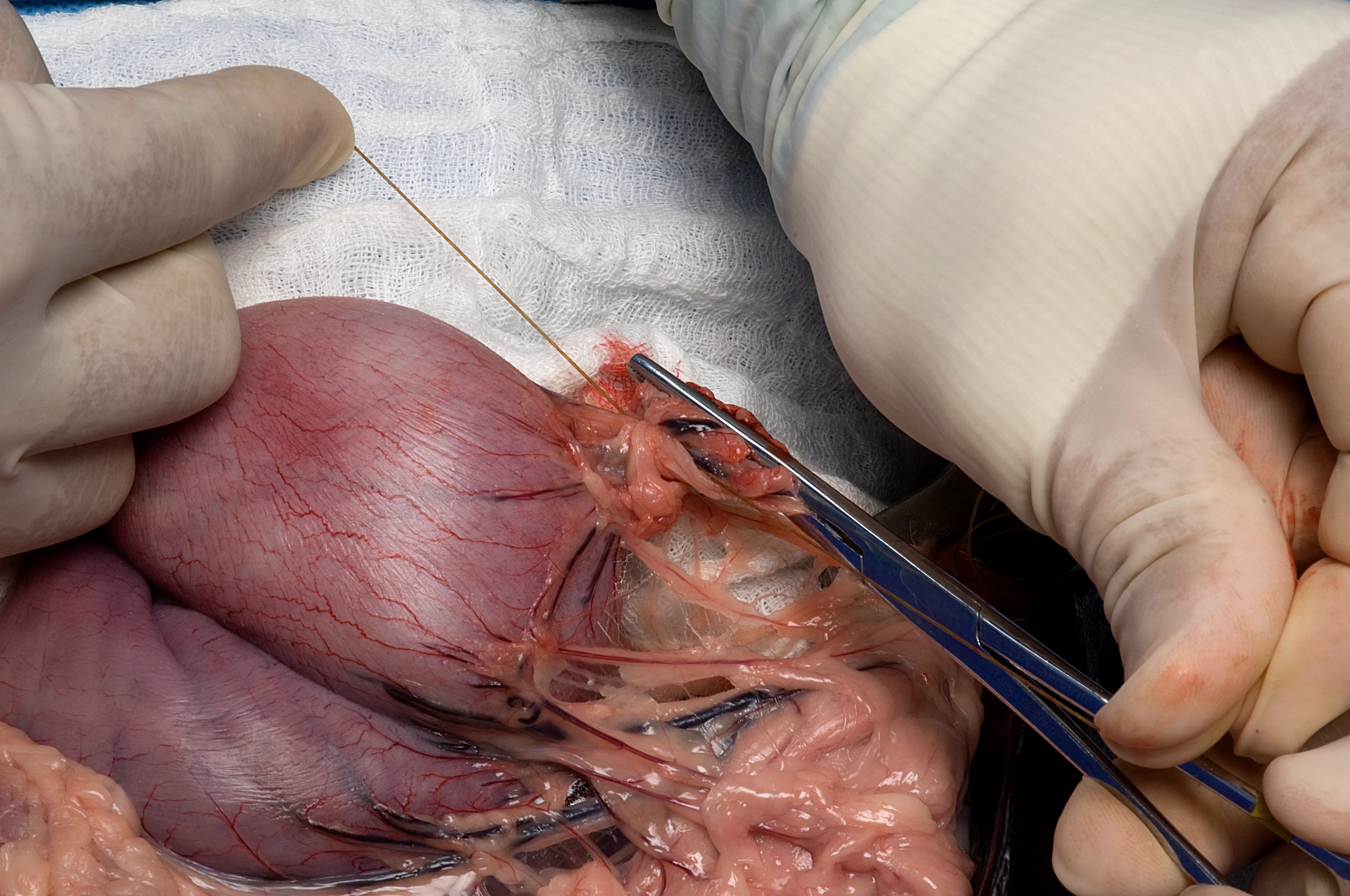 A surgeon’s hands are ligating vessels with suture material.