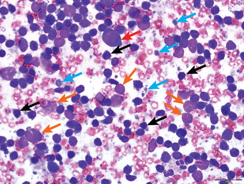 Clinical Image: Lymph Node Aspirate