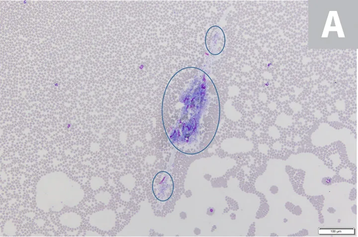 Figure 2A: A microscopic image of a blood smear showing clumped platelets. Figure 2B: A zoomed-in microscopic image of a blood smear showing clumped platelets.