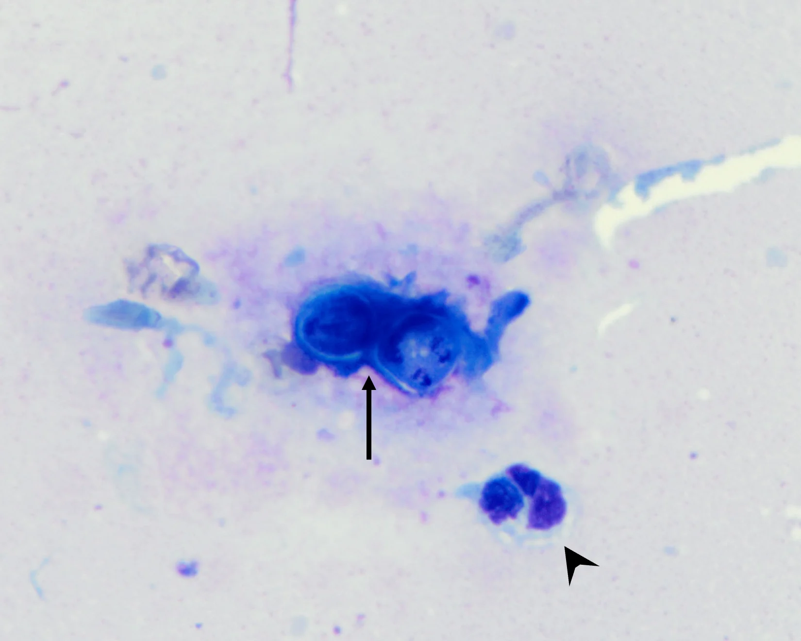Arrow pointing to 2 thick-walled, dark-staining yeast, and arrowhead pointing to a neutrophil.