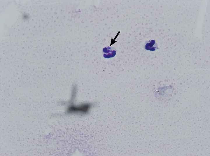 Two neutrophils, one with arrow pointing to a small round purple-staining object within the cytoplasm.