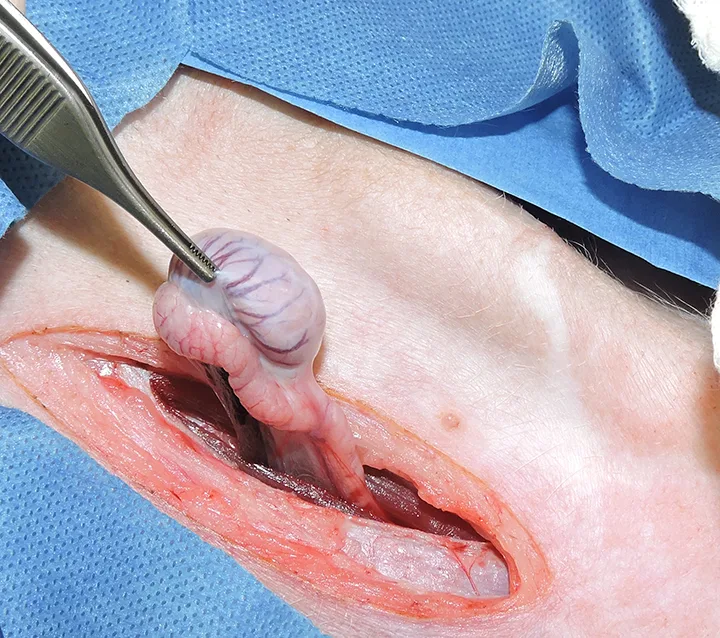 A cryptorchid testicle that has been located using a paramedian incision is being retained in forceps.