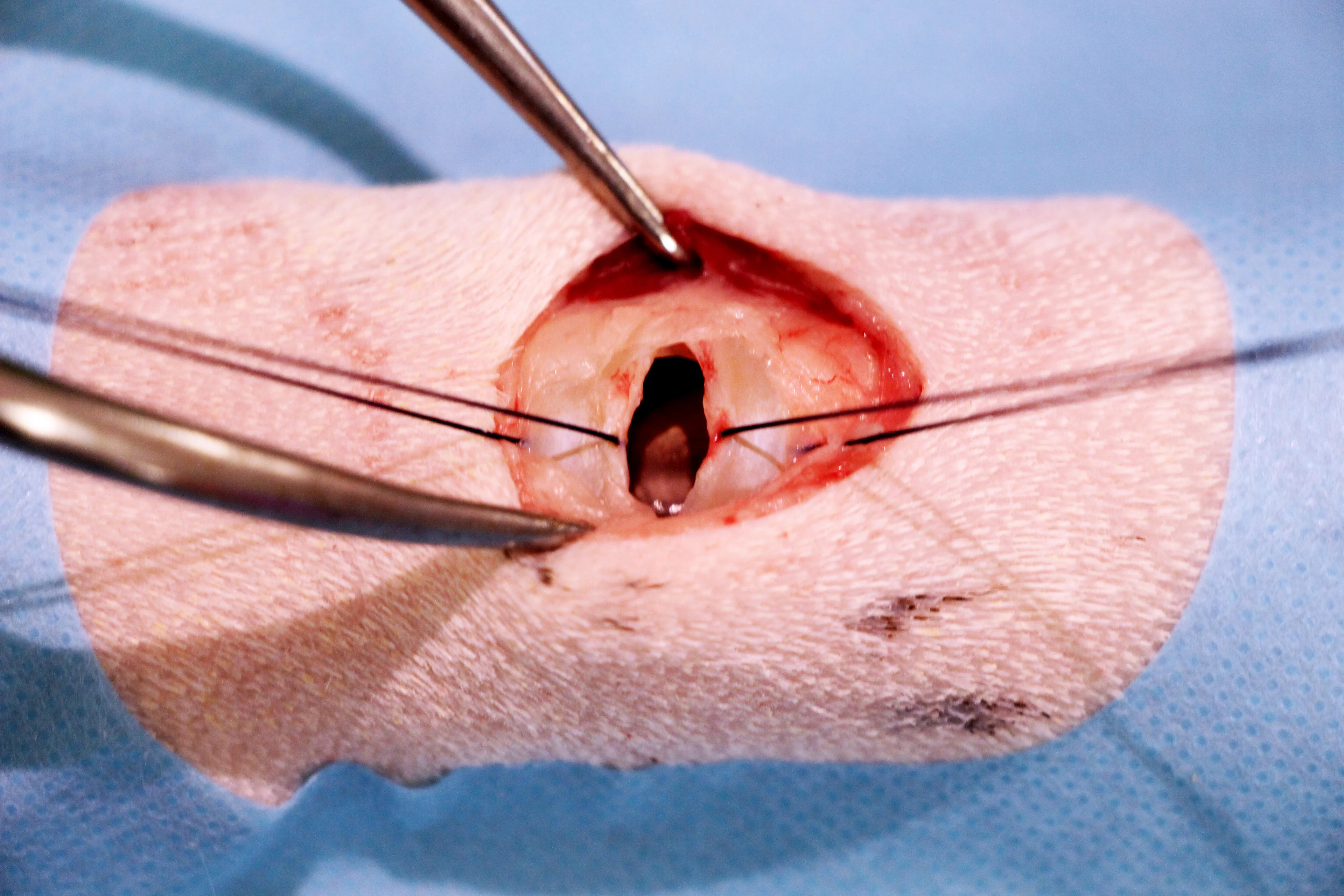 Traction being applied to sutures around tracheal rings and appearance of trachea after incising between sutures.