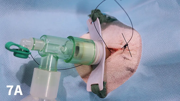 Tracheostomy tube in place with sutures labeled with surgical tape to indicate what direction to pull sutures to open site.