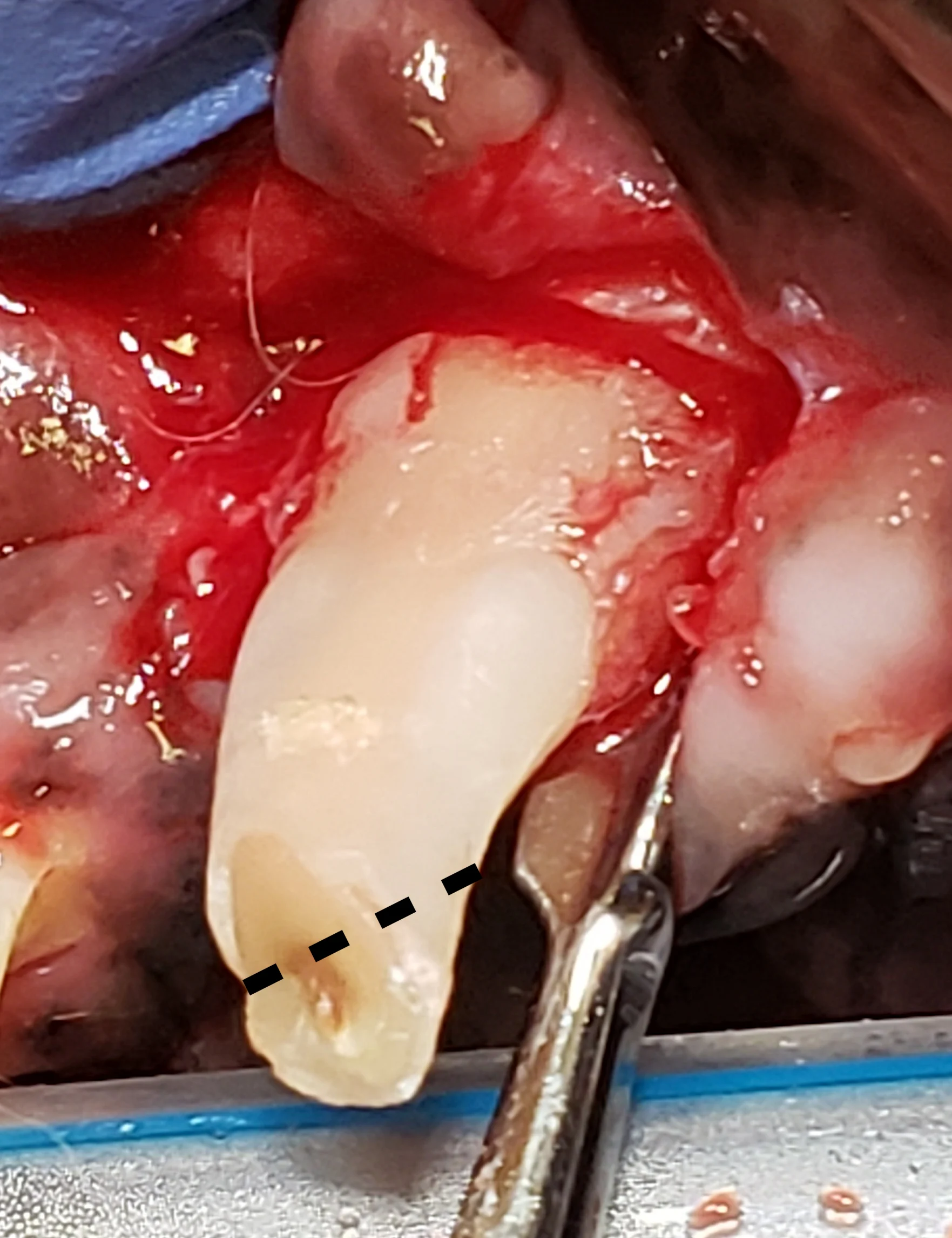 Winged elevator inserted into periodontal ligament space on distal side of canine tooth root.