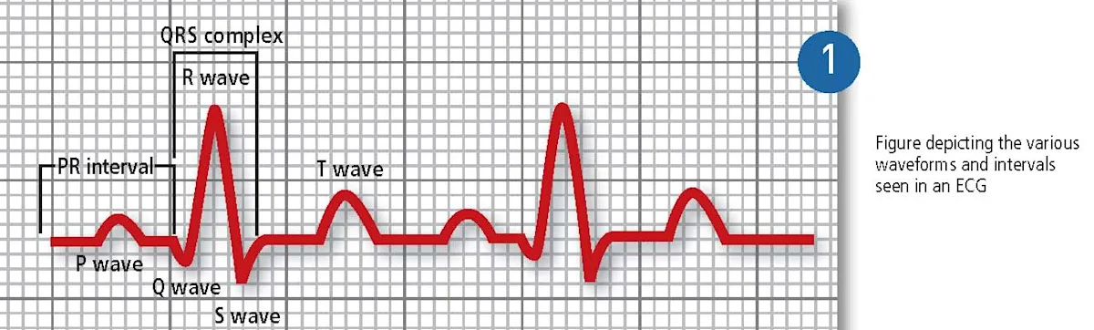 Illustration of a typical ECG waveform including labels for the P wave, QRS complex, and T wave.