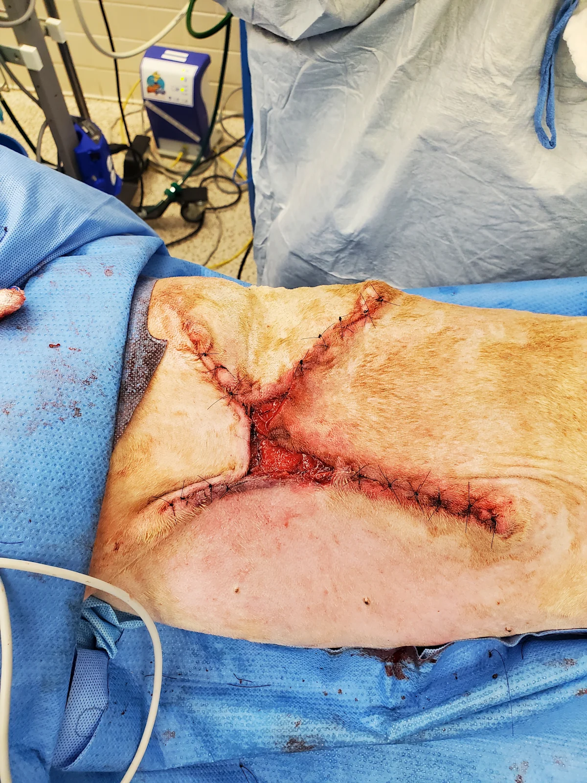Left: A granulation bed is present on the wound surface. Right: Post-op photo after partial wound closure. 