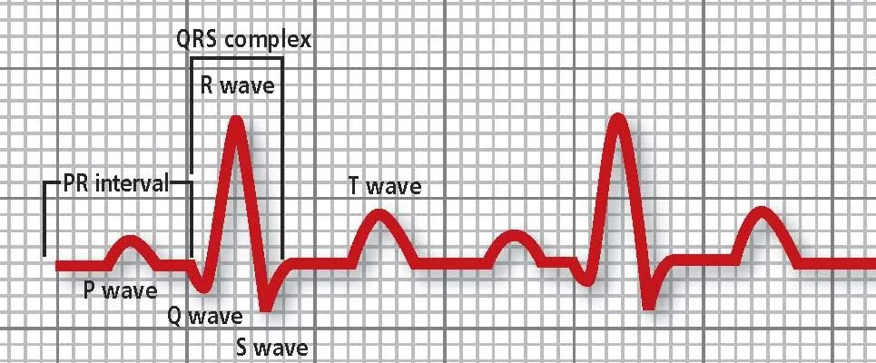 Graphic representation of the ECG complex with relevant parts labeled.
