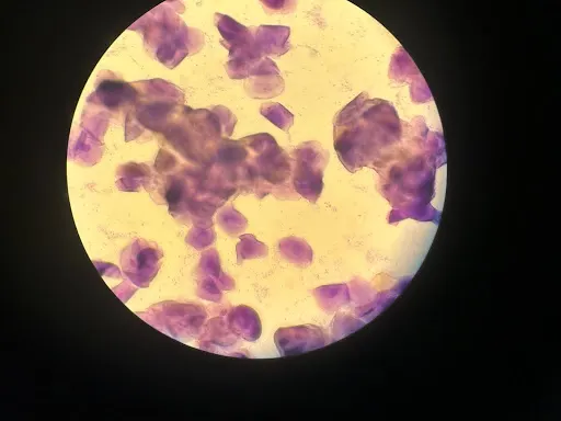 Vaginal cytology slide showing numerous angled cells.