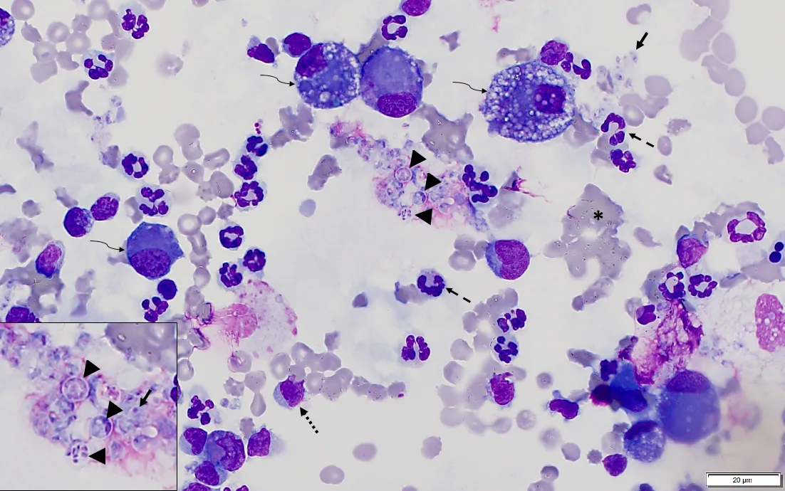 A microscopic image of stained cells from bronchoalveolar lavage. 