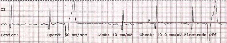 Two ECG tracings demonstrating narrow and wide premature QRS complexes.