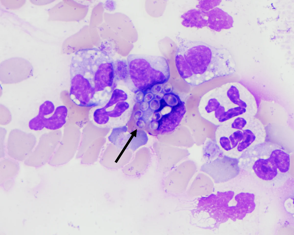 Arrow pointing to a cluster of ovoid to round organisms with clear capsules surrounded by white blood cells.