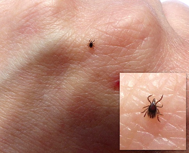 Clinical Image: What Species of Tick Is Shown?