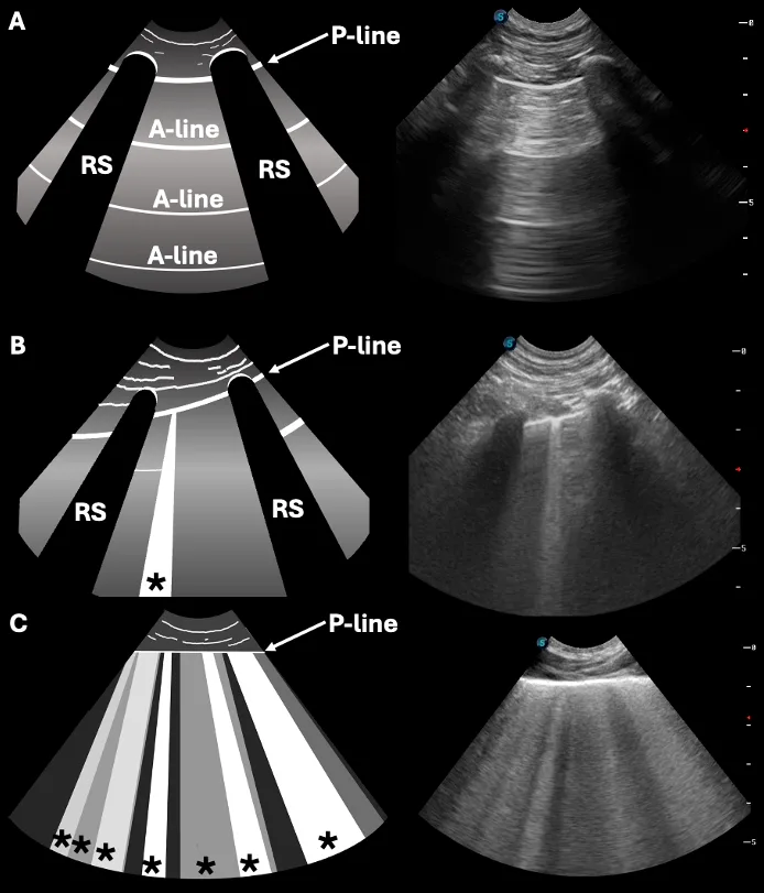 3 ultrasound images of dog lung with corresponding schematics illustrating A- and B-lines in healthy lung and increased B-lines in a dog with congestive heart failure.