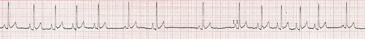 ECG tracing showing irregular R-R intervals.