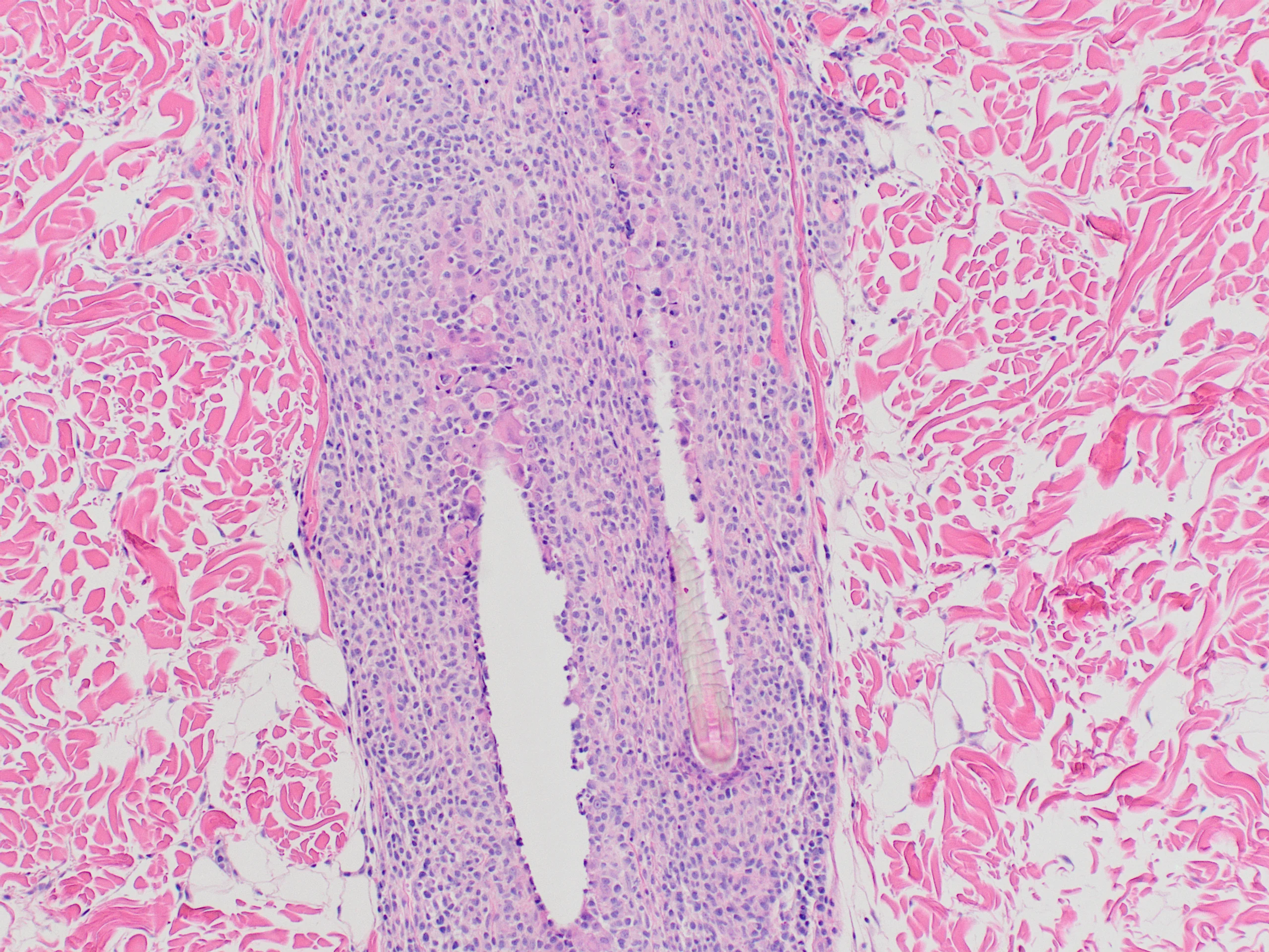Histopathology slide of skin showing numerous lymphocytes throughout hair follicle.