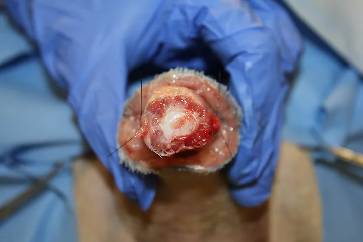 Incised end of amputated tail demonstrating how to close skin over bony vertebra.