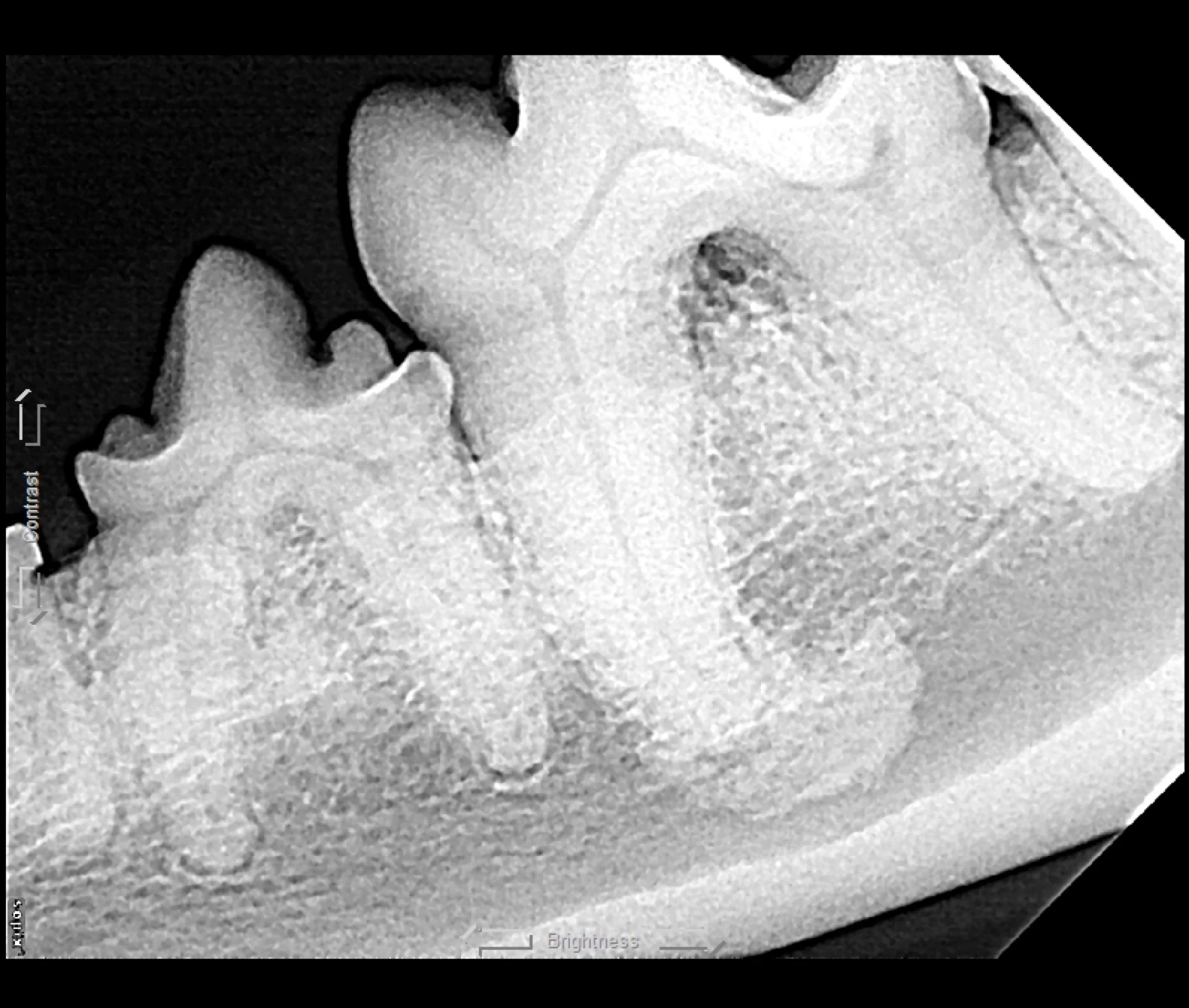Four dental radiographs showing different root anomalies that can contribute to root fracture during extraction. 