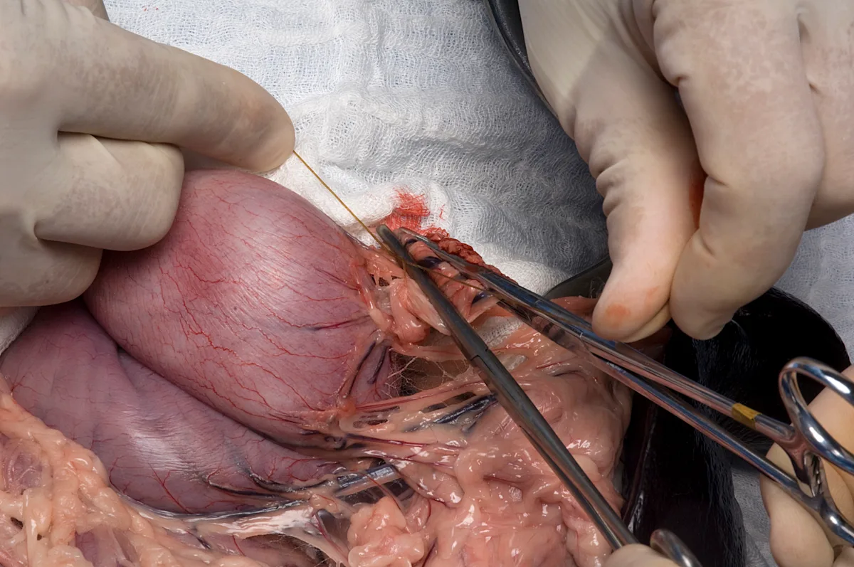 A surgeon’s hands are ligating vessels with suture material.