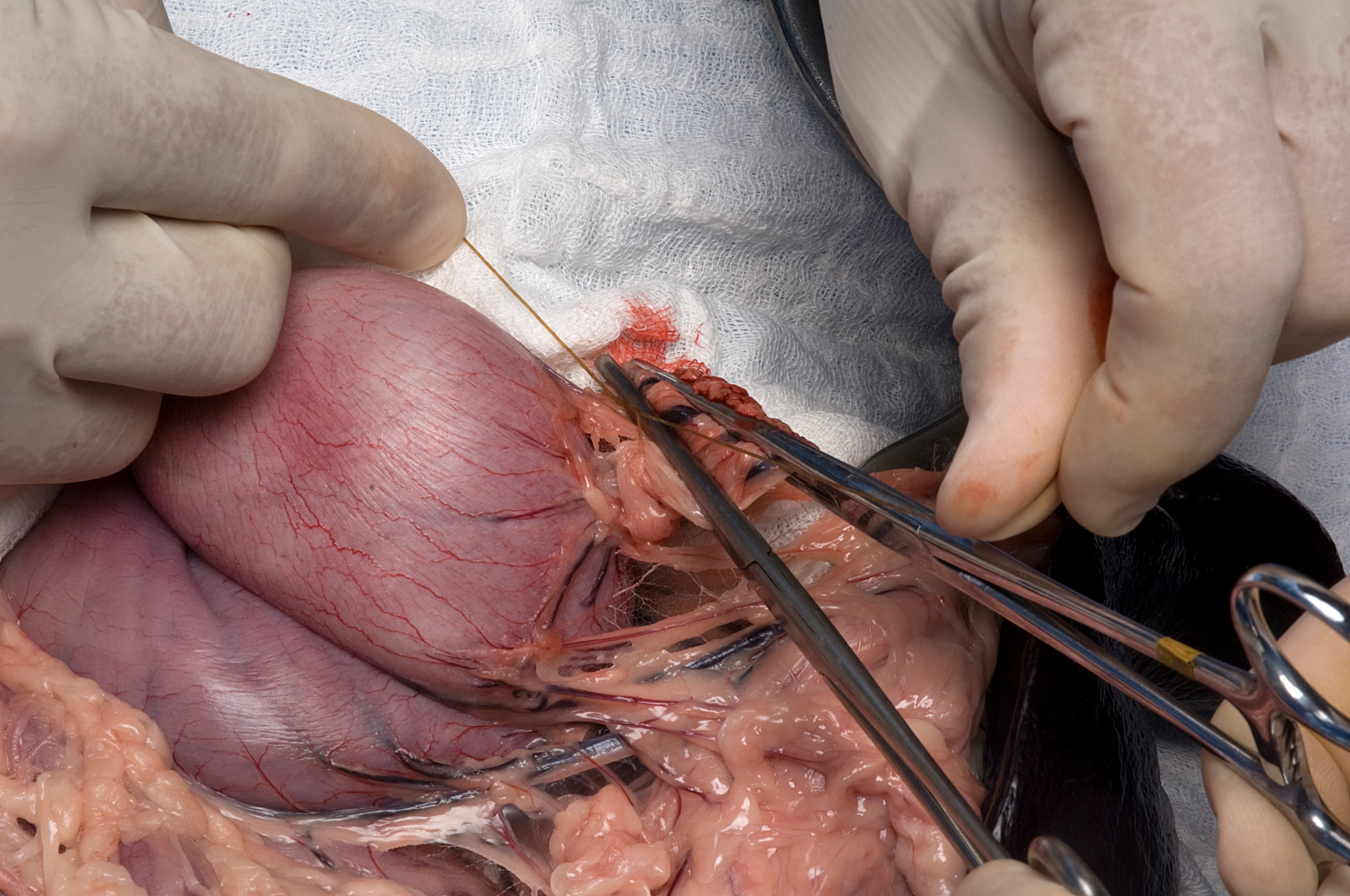 A surgeon’s hands are ligating vessels with suture material.