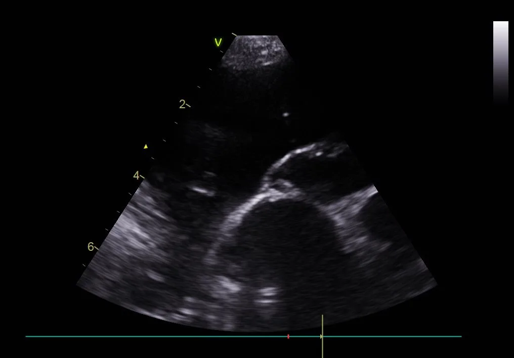 Thoracic ultrasound showing large anechoic areas of pleural effusion.