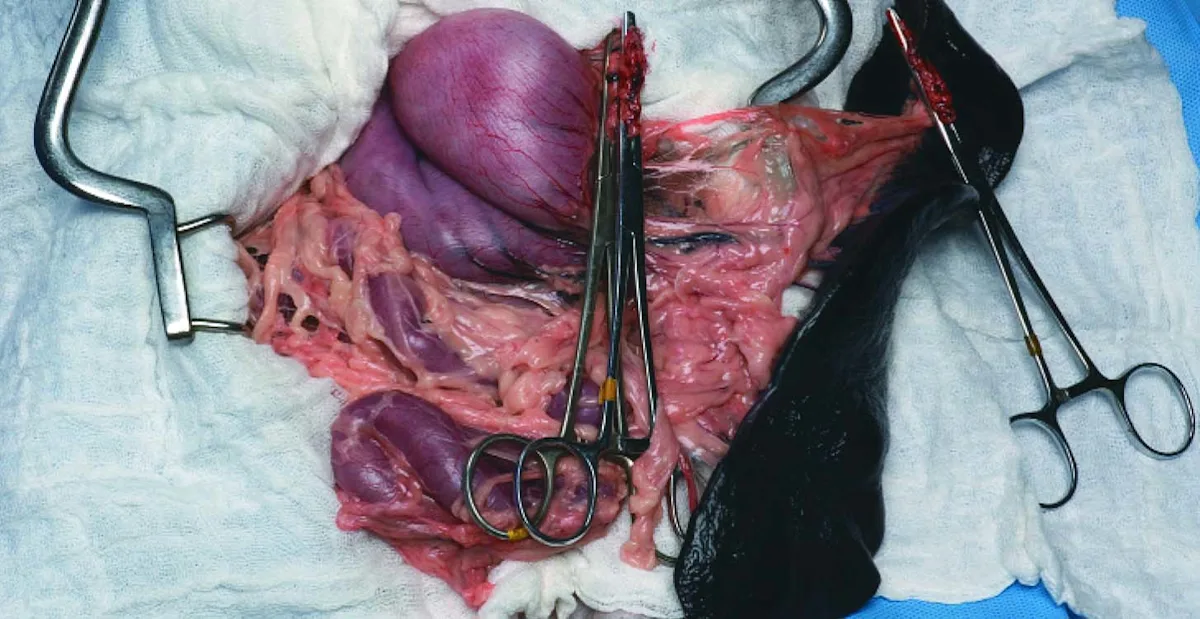 The short gastric vessels have been clamped and incised, freeing the head of the spleen.
