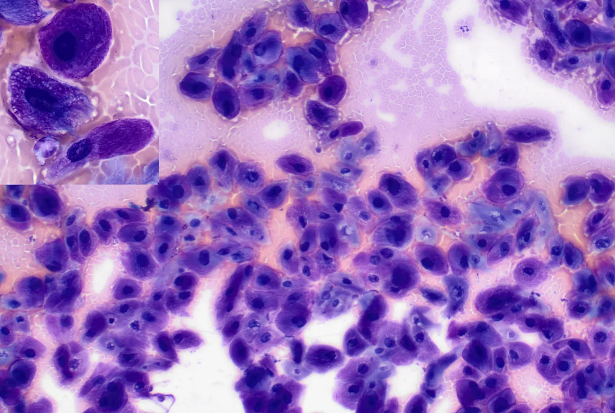 Cells of varying shape and size with purple cytoplasm and dark purplish black nuclei.