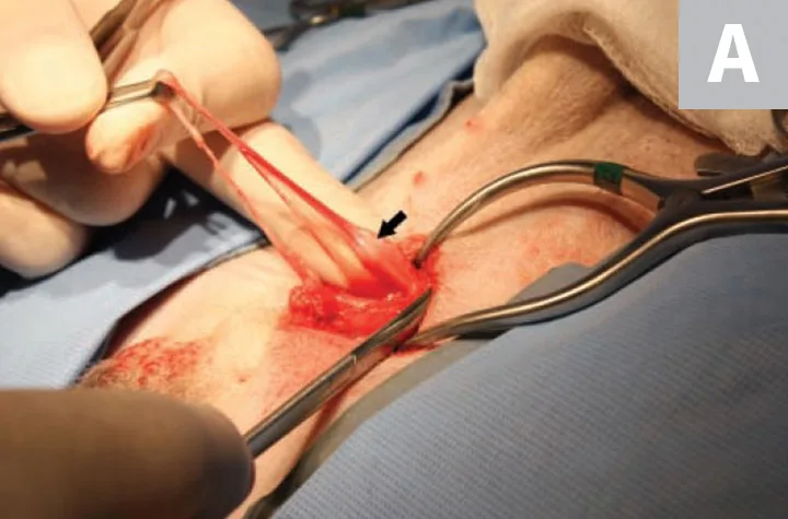 In Figure 1A, an inguinal incision has been made and the gubernaculum is being gently retracted. In Figure 1B, the cryptorchid testicle is now visible in the surgical field.