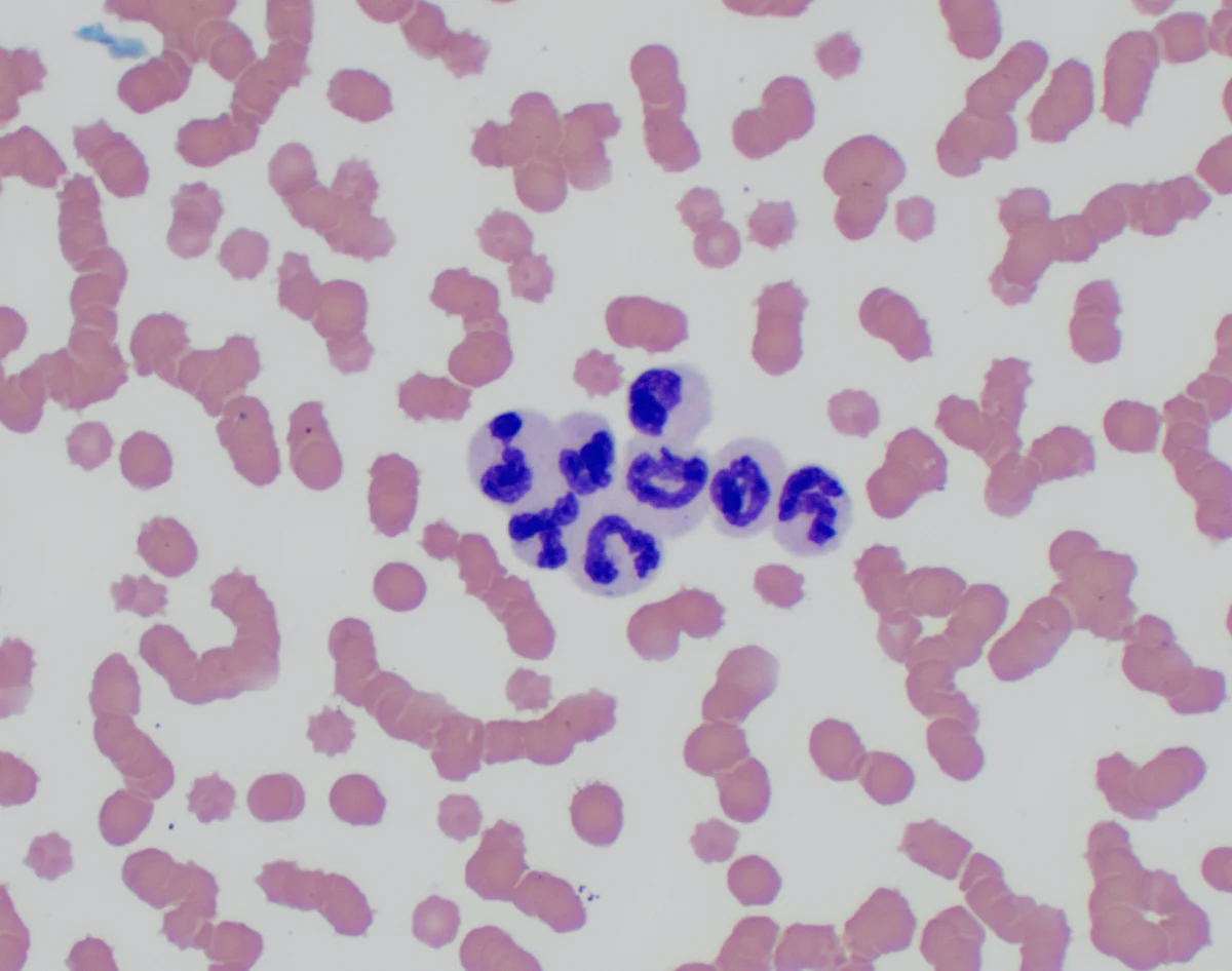 Blood smear showing 8 clumped neutrophils surrounded by red blood cells.
