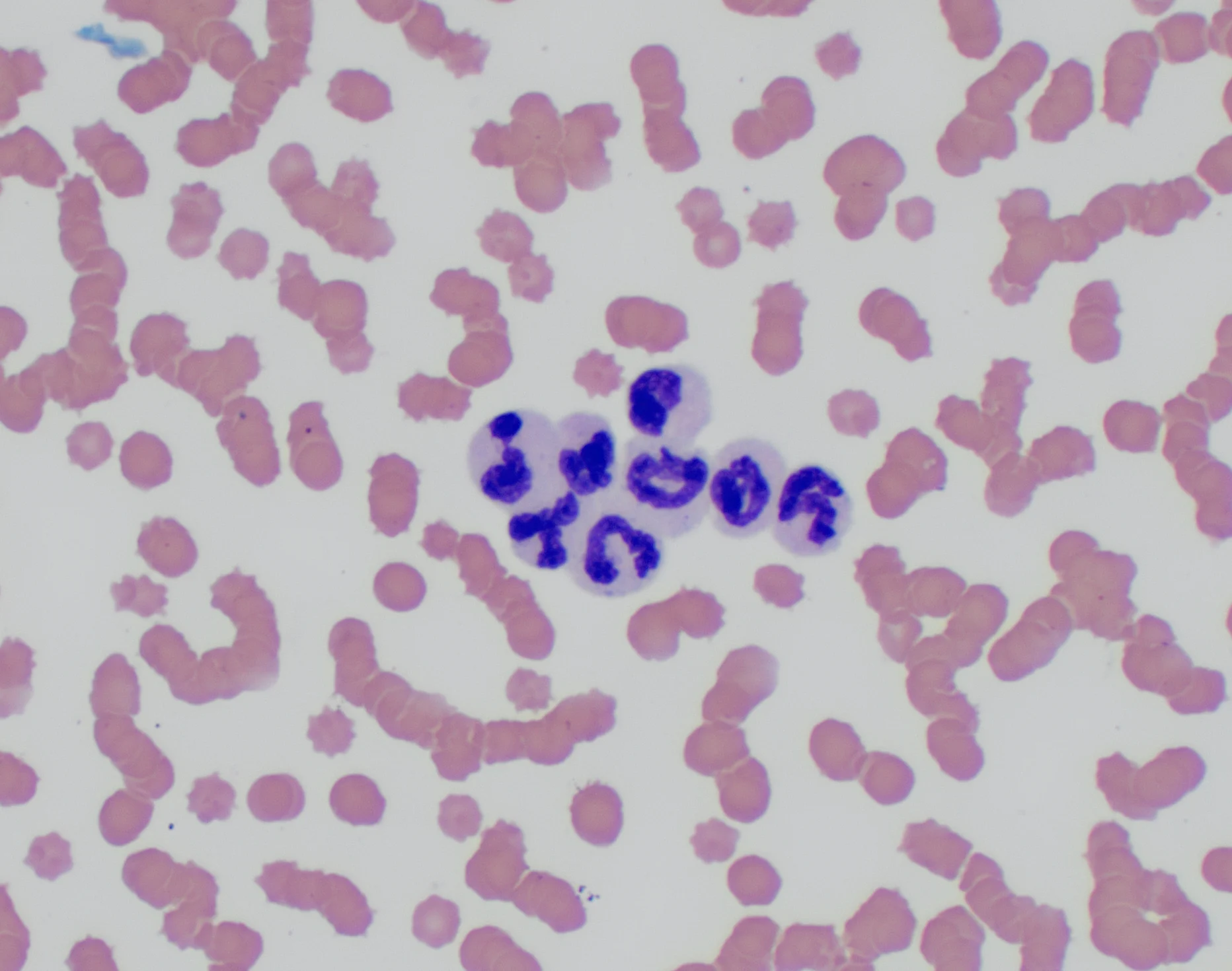 Blood smear showing 8 clumped neutrophils surrounded by red blood cells.
