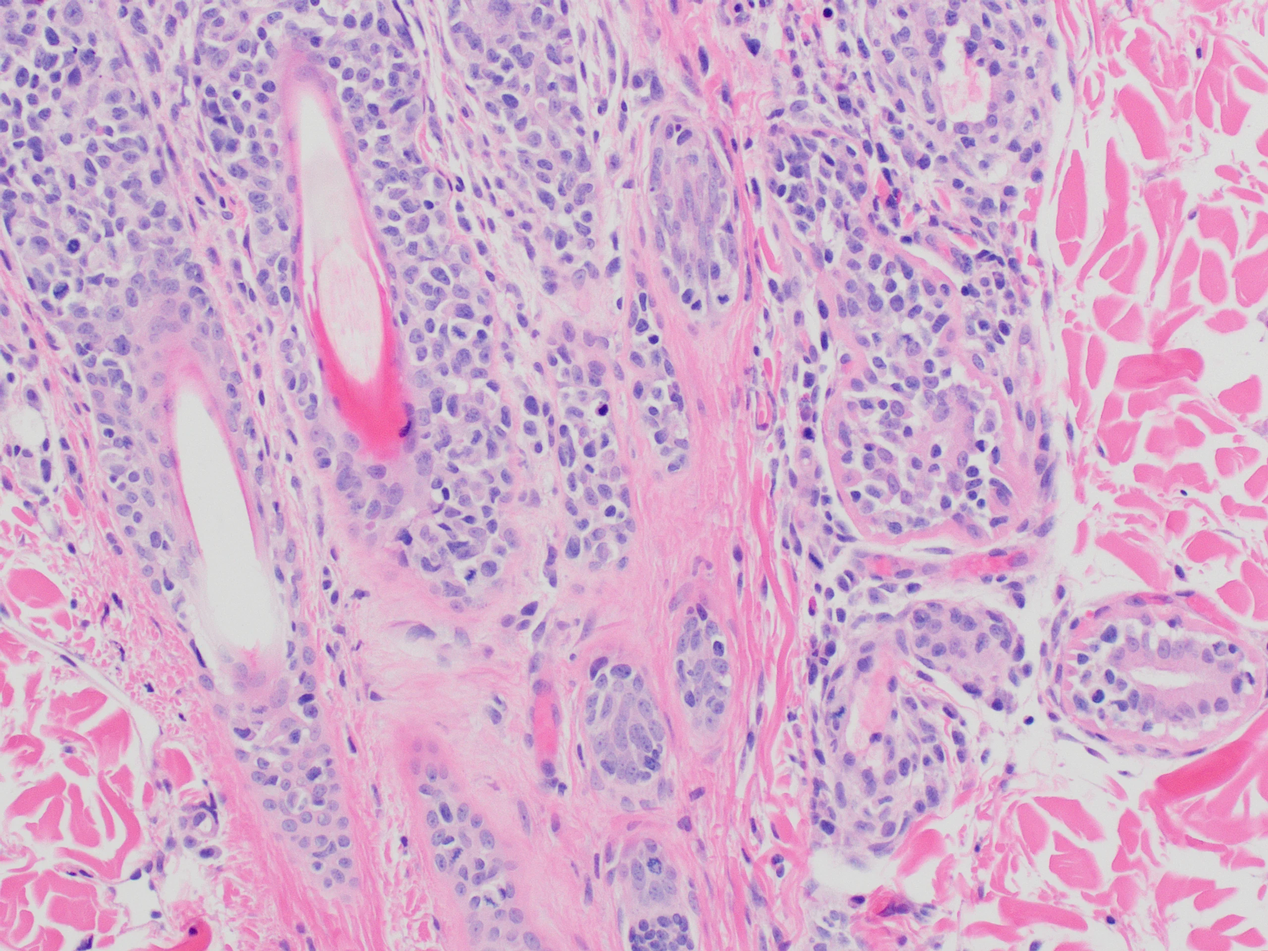 Histopathology slide of skin showing numerous lymphocytes throughout sweat gland.