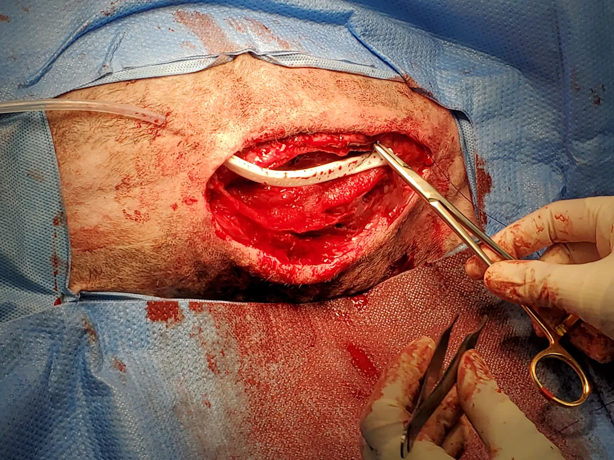 A perioperative photo shows a continuous suction drain being placed in the incision prior to closure. 