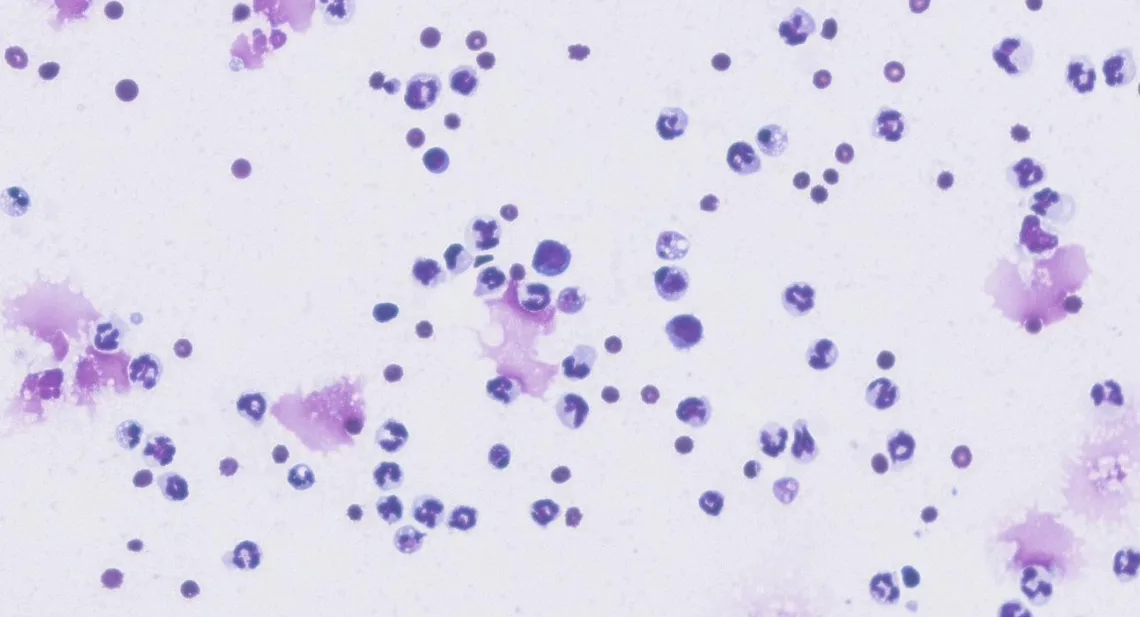 Cytology of pleural fluid showing moderate numbers of inflammatory cells.
