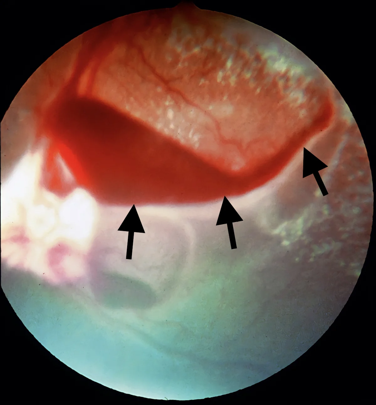 Intraocular image showing retina in background and arrows pointing to vascular red structure in foreground.