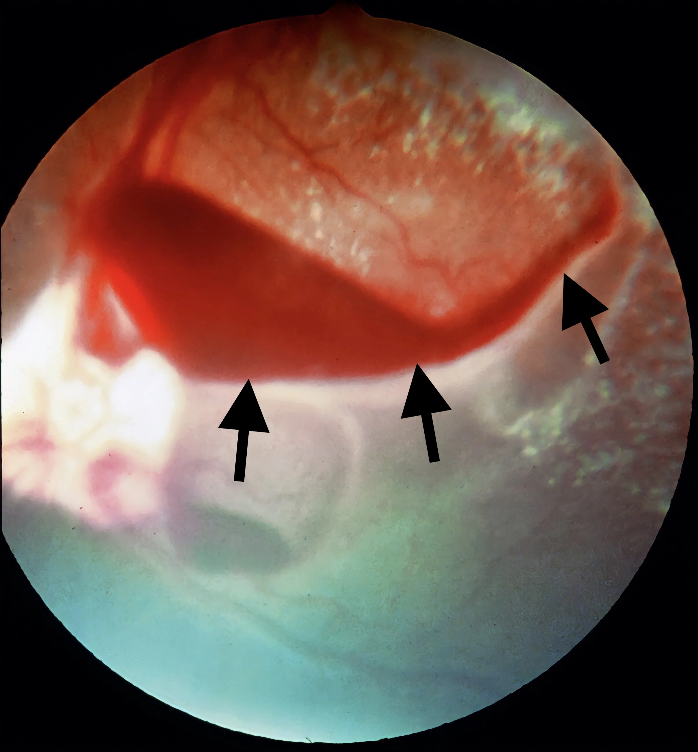 Intraocular image showing retina in background and arrows pointing to vascular red structure in foreground.