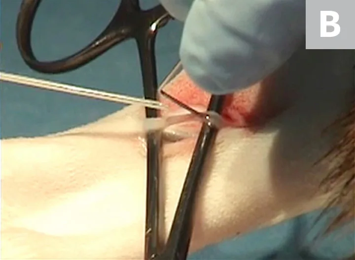 Two images showing incising of saphenous vein and bent needle inserted into incised vein to ready it for catheterization.