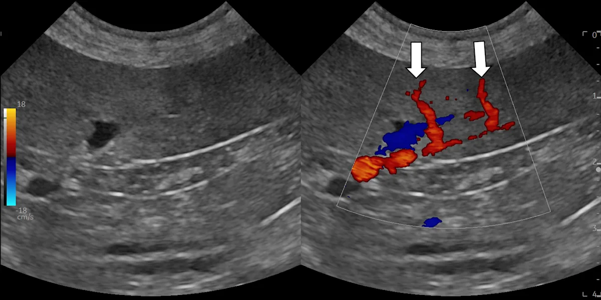 An ultrasound image of spleen with color Doppler showing location of splenic arteries.