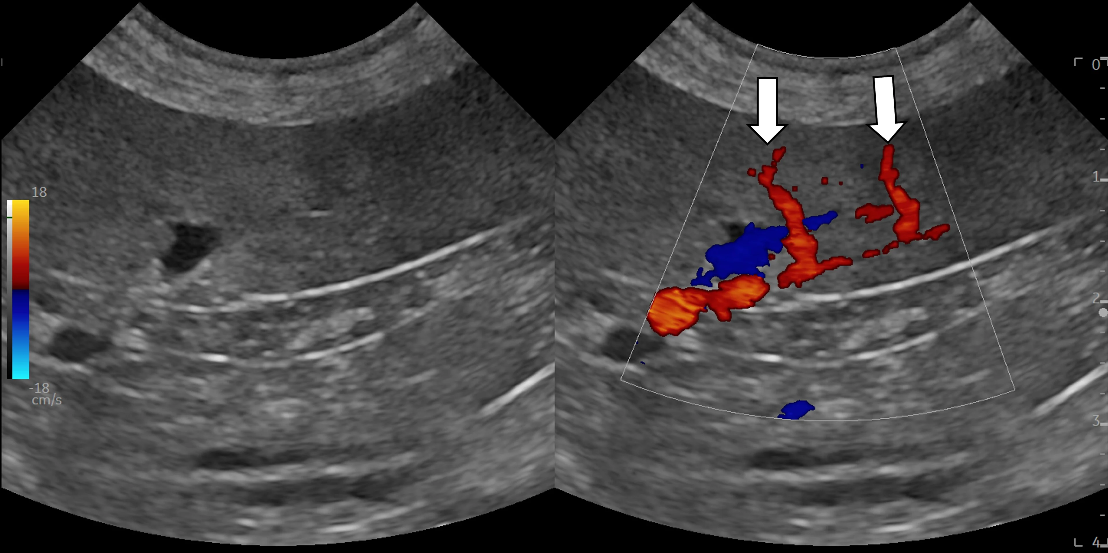 An ultrasound image of spleen with color Doppler showing location of splenic arteries.