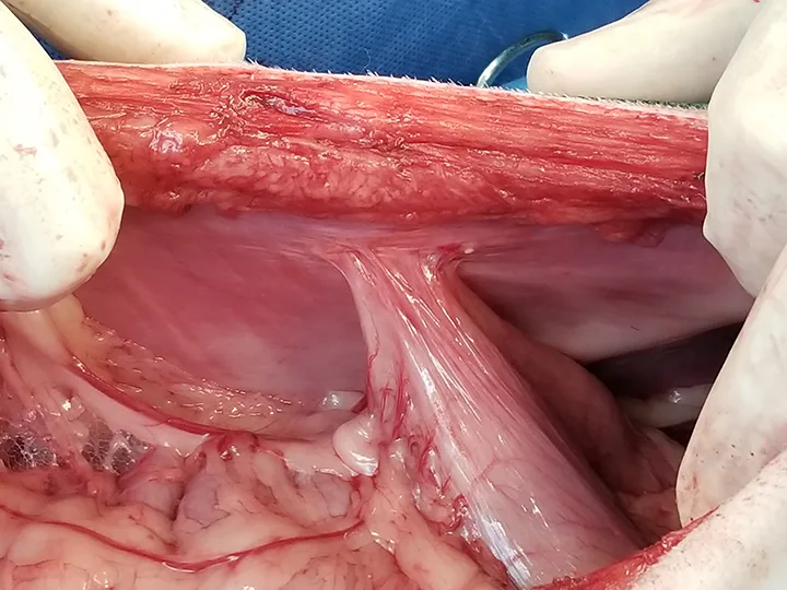 Intraoperative image of healthy-looking antimesenteric side of stomach adhered to internal body wall.