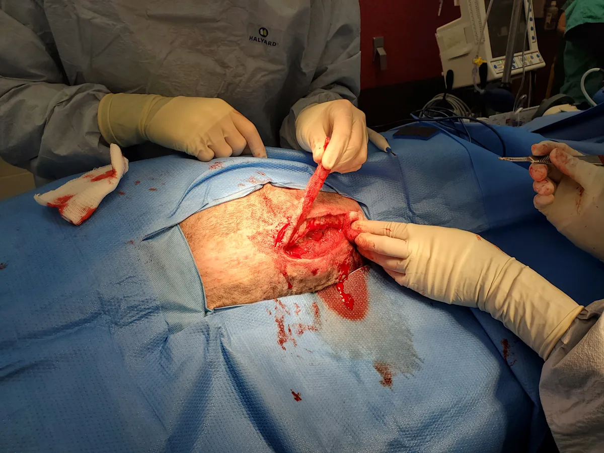 A perioperative photo shows the lateral margins of the incision being debrided.