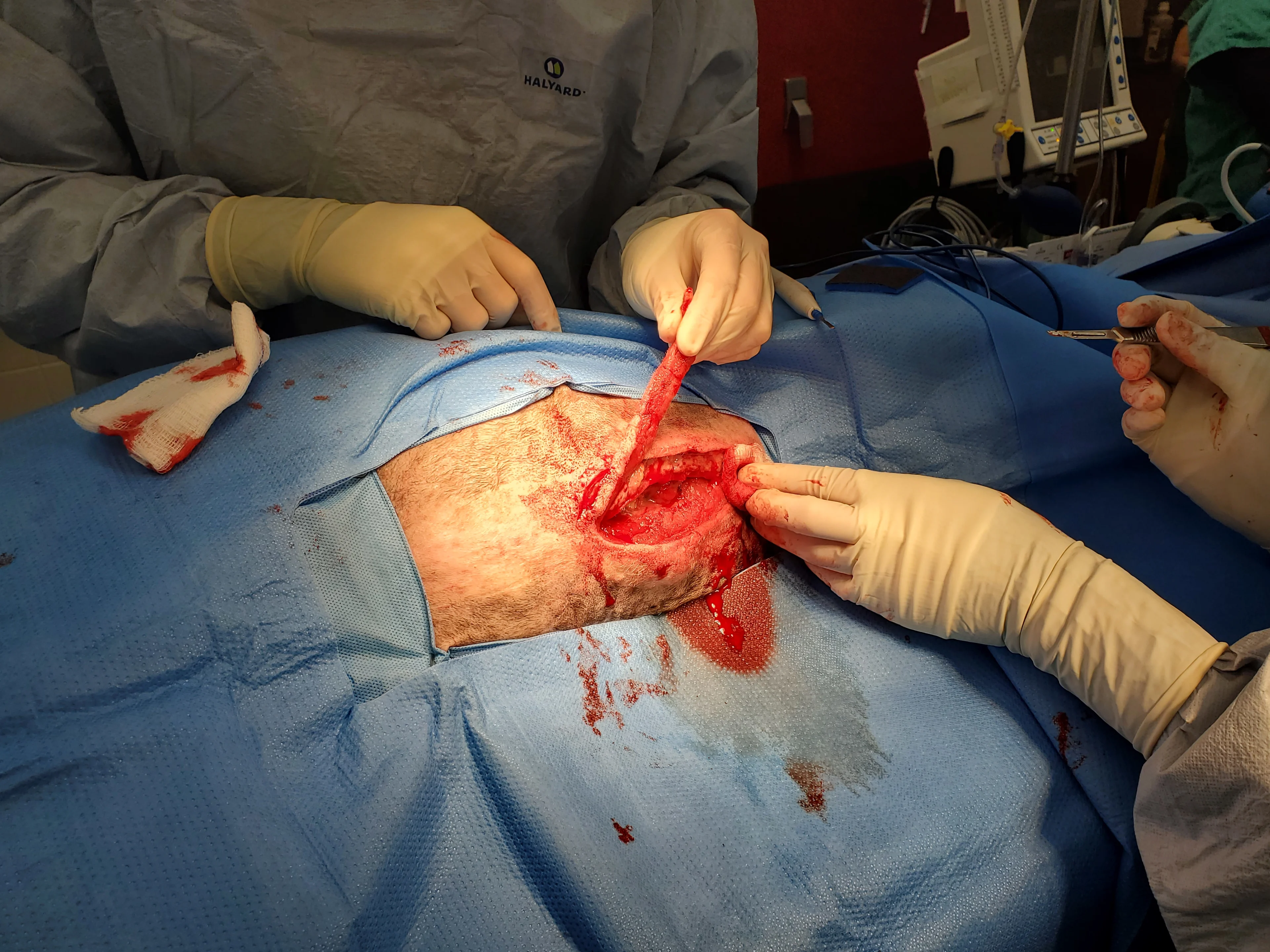 A perioperative photo shows the lateral margins of the incision being debrided.