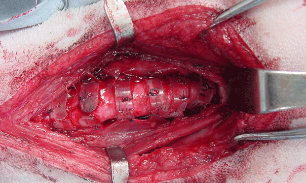 Collapsed 2025 trachea surgery