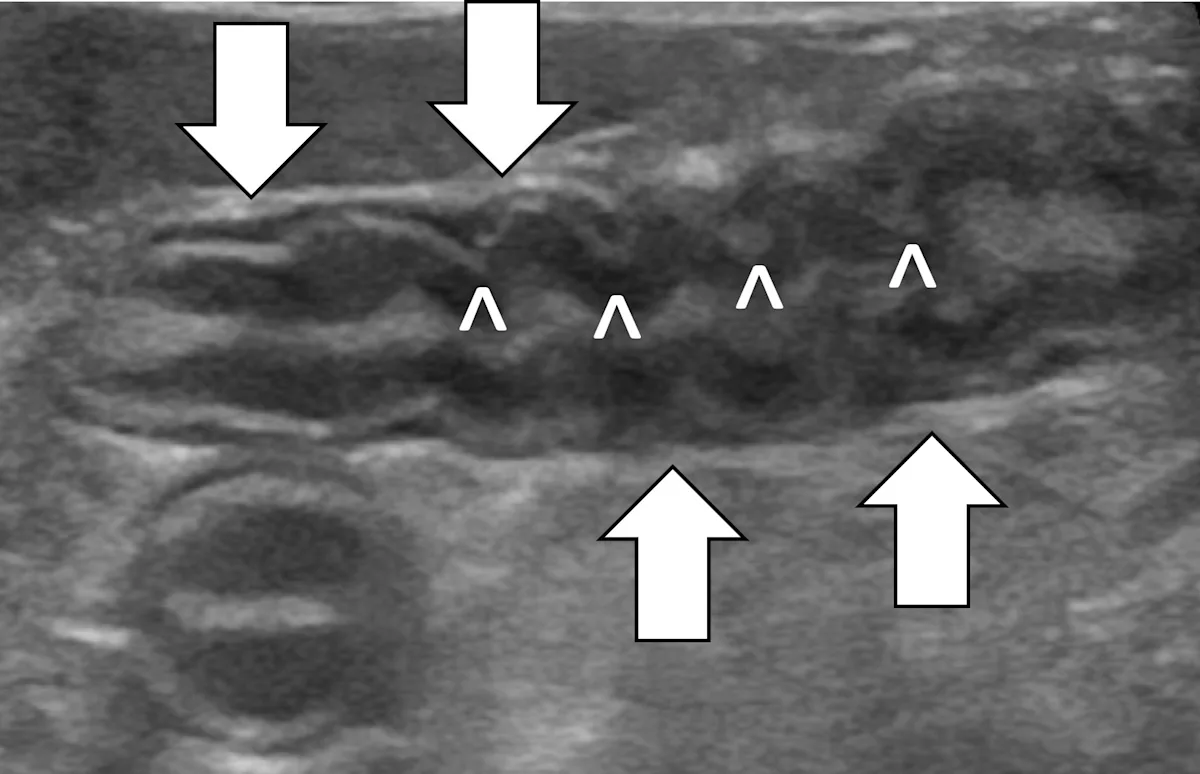 Ultrasound image of jejunum showing signs of inflammatory bowel disease with abnormalities labelled.