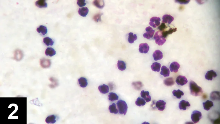 Cytology of septic joint fluid.