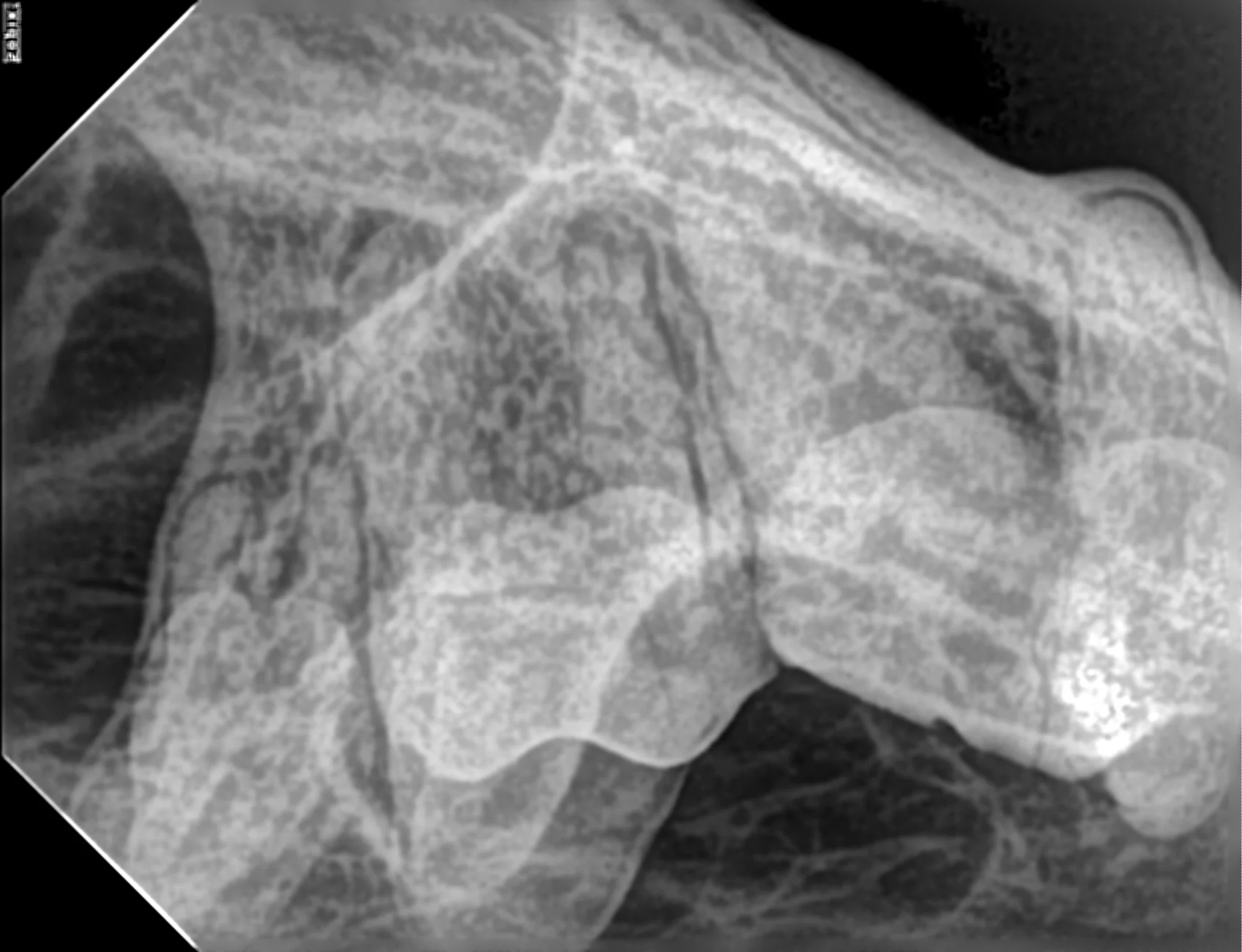 Intraoral radiograph of right maxillary molars using intraoral bisecting angle technique.
